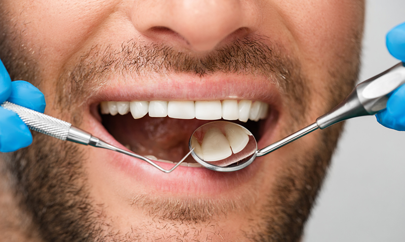 Healthy white male smile with a periodontal probe and mouth mirror, close-up. Teeth treatment.