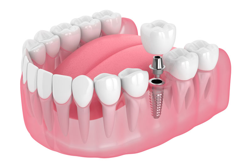 single dental implant 3d model on a white background